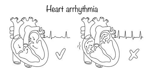 Heart arrhythmia