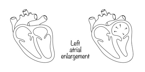 Left atrial enlargement