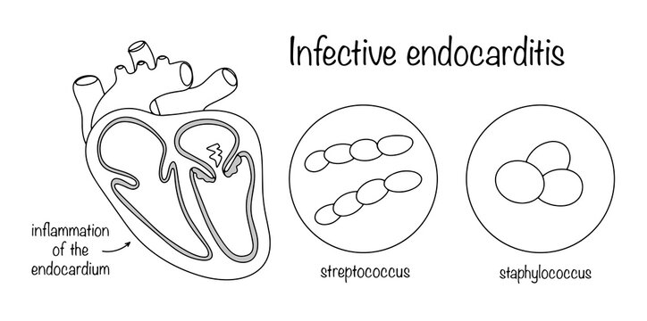 Infective endocarditis