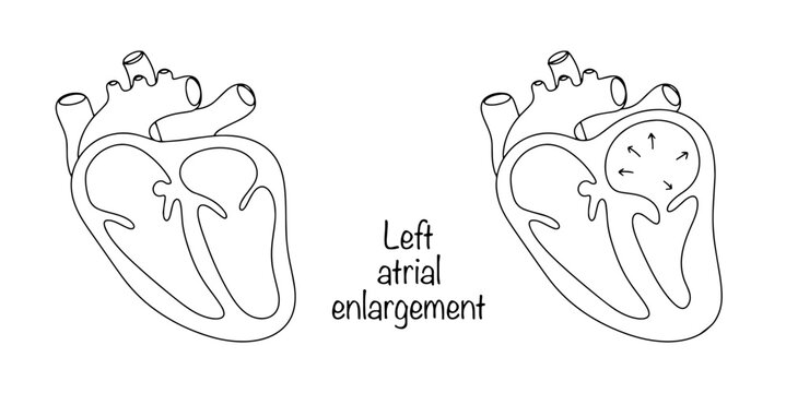 Left atrial enlargement