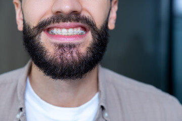 Unrecognizable man with cheerful smile showing clear ceramic braces