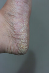 Close up of dry cracked skin on foot