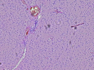 Photomicrograph shows the histology of glioblastoma multiforme (GBM), a type of brain cancer.