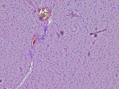 Photomicrograph shows the histology of glioblastoma multiforme (GBM), a type of brain cancer.
