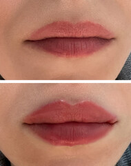 collage before and after lips after the enlargement procedure
