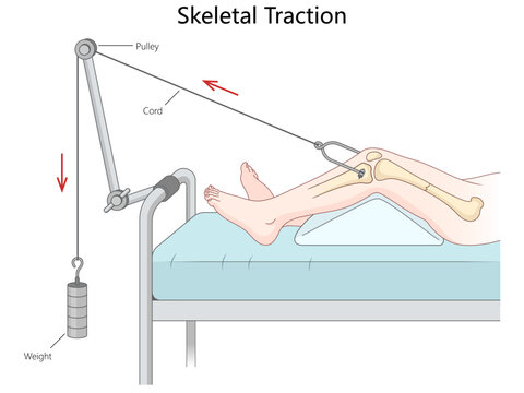 skeletal traction using weights and pulleys to align a leg fracture, showing the mechanism components and setup hand drawn schematic vector illustration. Medical science educational illustration