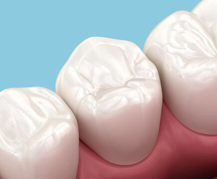 Decayed tooth restoration with composite filling. Dental 3D illustration