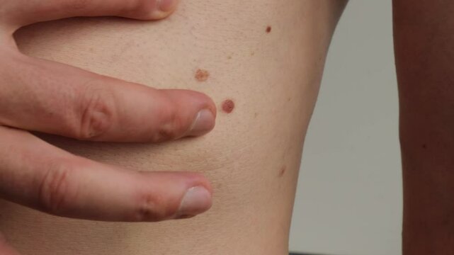 Unrecognizable man showing his birthmarks on skin Close up detail of the bare skin Sun Exposure effect on skin. Health Effects of UV Radiation Male with birthmarks Pigmentation and lot of birthmarks