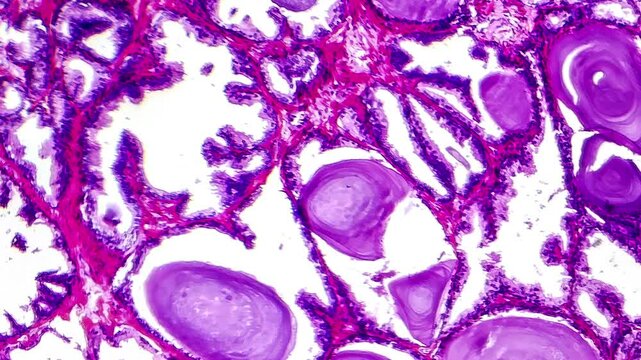 Light microscopy of tissue of a patient with benign prostatic hyperplasia (enlarged prostate). This is characterised by dilated glands and papillary projections inside the glands lumen.