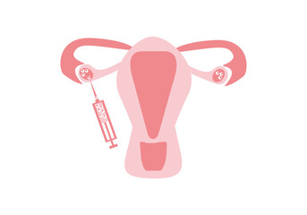 IVF stage, egg puncture, oocyte collection, IVF - vector, flat color illustration
