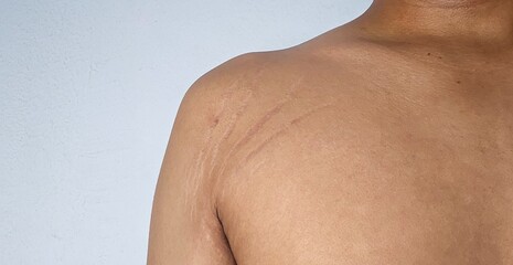 stretch marks on armpit skin area	
