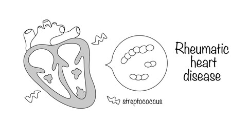 Rheumatic heart disease