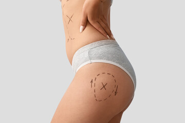 Young woman in underwear with marks on her body against light background, closeup. Plastic surgery...