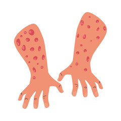 human hands with monkeypox virus