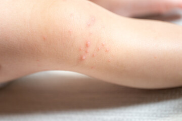 手足口病に罹患した一歳の男の子