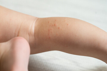 手足口病に罹患した一歳の男の子