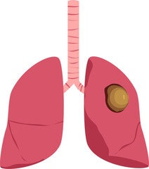 Lung disease. Respiratory disease illustration.
