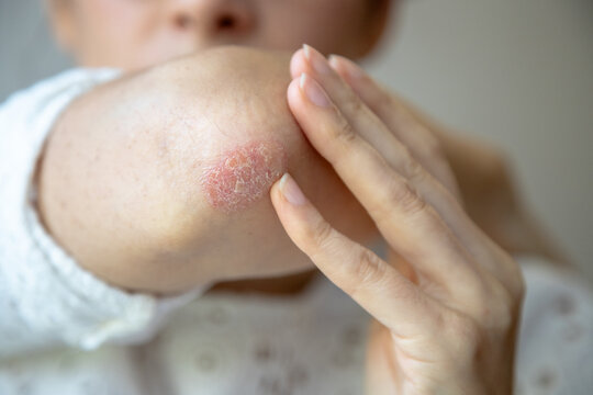Close-up of a person touching a red, dry patch of skin on their elbow, showing signs of psoriasis or eczema, highlighting a skin condition that requires treatment or care.
