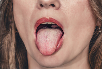 Detail of woman's tongue with white plaque. Plaque on tongue indicates gastroenterological problems.