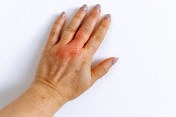 female hand with pigment spots on skin, swollen finger from insect bite