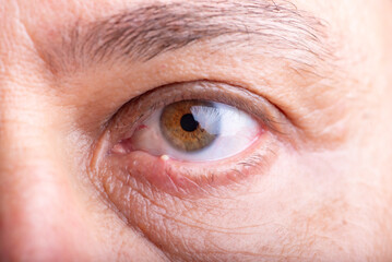 Ophthalmic hordeolum, close-up of an adult male eye with a stye (ophthalmic hordeolum), selective focus.