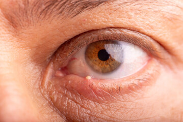 Ophthalmic hordeolum, close-up of an adult male eye with a stye (ophthalmic hordeolum), selective...