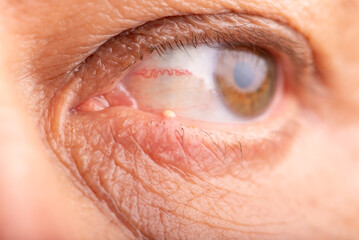 Fototapeta premium Ophthalmic hordeolum, close-up of an adult male eye with a stye (ophthalmic hordeolum), selective focus.