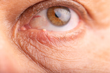 Fototapeta premium Ophthalmic hordeolum, close-up of an adult male eye with a stye (ophthalmic hordeolum), selective focus.