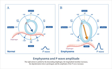 When emphysema occurs, the diaphragm moves downwards, pulling the right atrium, causing an increase...