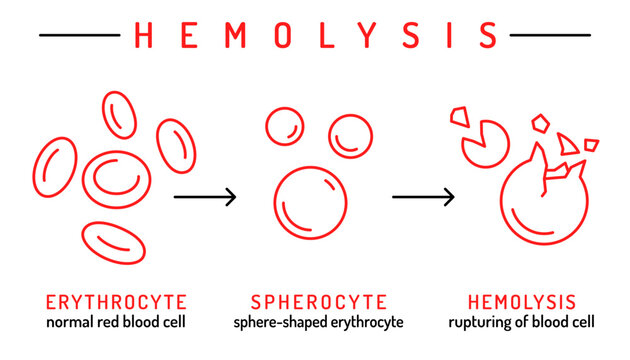 Hemolytic anemia infographic. Vector illustration isolated on a white background