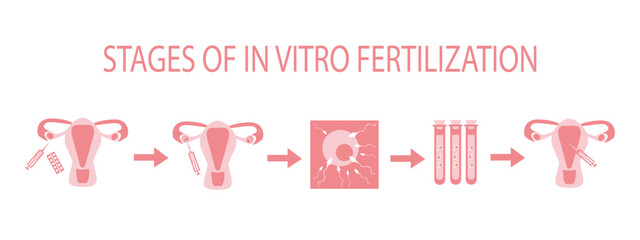 Stages of in vitro fertilization, IVF scheme - vector, flat color illustration