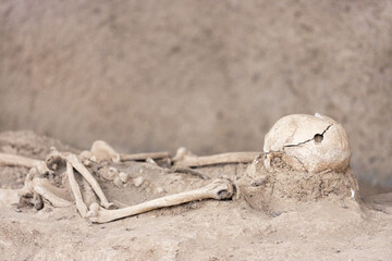 Trepanned skeleton with surgery intervention skull burr hole. Human skull with trepanation.