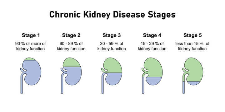 Chronic Kidney Disease (CKD) Stages Scientific Design. Vector Illustration.
