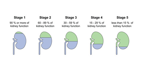 Chronic Kidney Disease (CKD) Stages Scientific Design. Vector Illustration.
