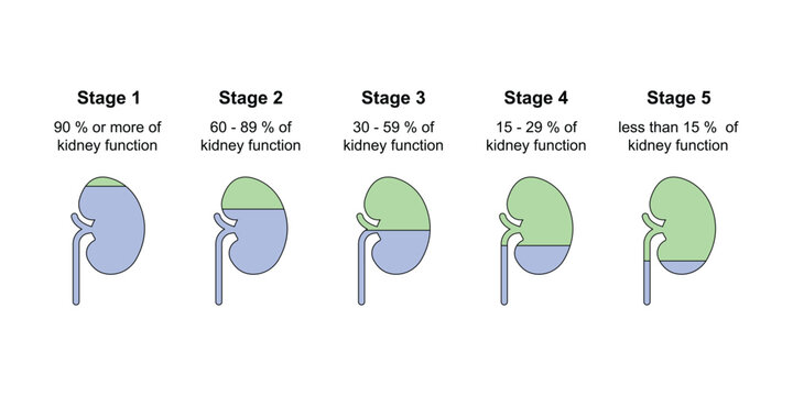 Chronic Kidney Disease (CKD) Stages Scientific Design. Vector Illustration.
