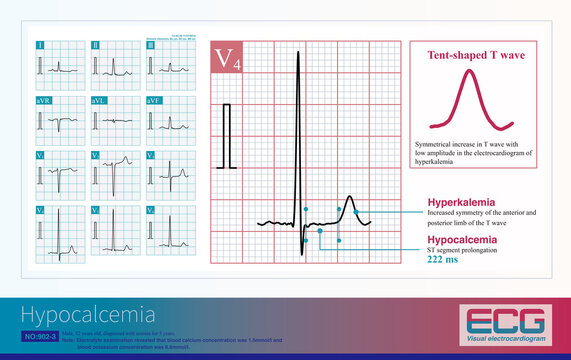 Hypocalcemia and hyperkalemia are common mixed electrolyte imbalances in late stage patients with chronic renal failure.
