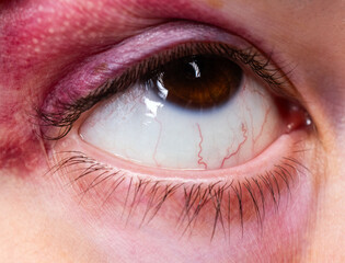 Close up of a Woman with a black eye 