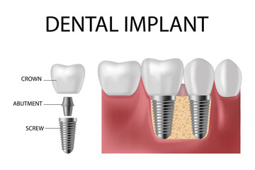 Dental implant. Screw prosthesis, orthodontic dental implantation