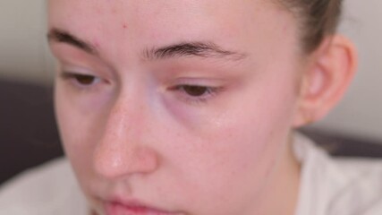 Young woman worried about face. Dermatology and allergic to steroids in cosmetics.