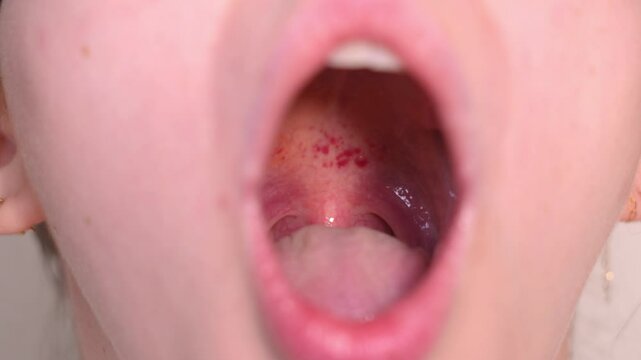 A Lady Opens Her Mouth to Examine Her Throat Rash - Close Up