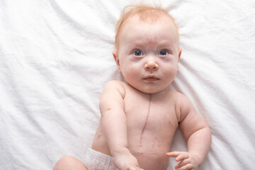 little girl with a scar from heart surgery