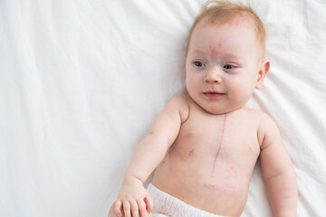 little girl with a scar from heart surgery