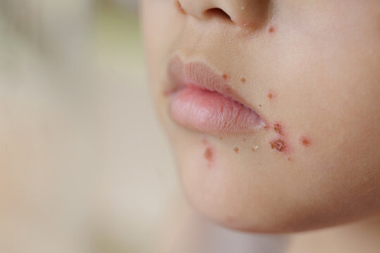 A young child has a red rash on his face. He has hand, foot and mouth disease. The rash appears on his face and itches.