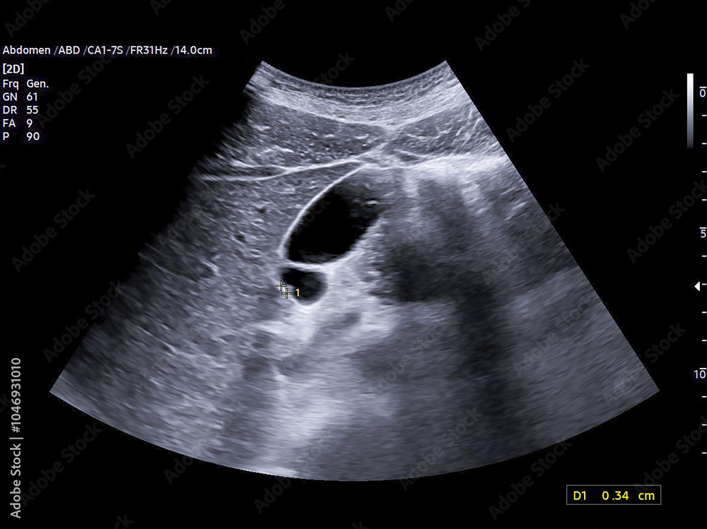 Poster ultrasound scan of the upper abdominal region showing several small gallbladder polyps, perfect for 