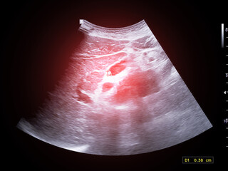 Ultrasound scan of the upper abdominal region showing several small gallbladder polyps, perfect for...