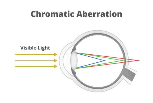 Vector illustration of chromatic aberration or refraction of light in the human eye. Shorter wavelength rays are focused in front of the retina, longer wavelength rays are focused behind the retina. 