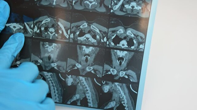 Computed tomography of the thyroid gland.