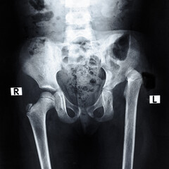 X ray pelvis showing developmental dysplasia of hip in left side 