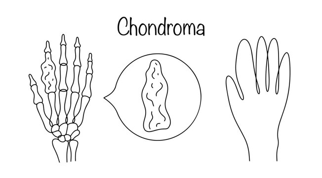 Chondroma