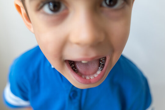 Dental care concept. Stainless steel crown a silver cap used for restoring children's teeth